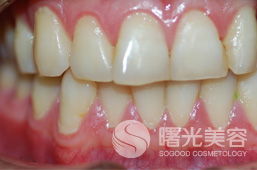 曙光第三代冷光美白 广州曙光整形美容医院牙科引领微笑焕新革命